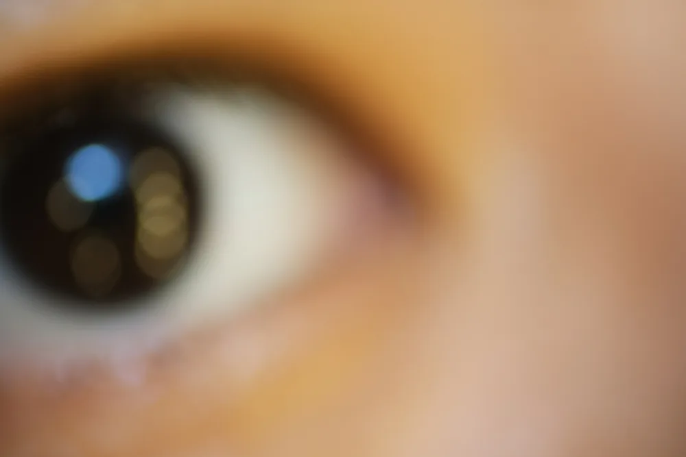 Vision Be Blurry After LASIK
